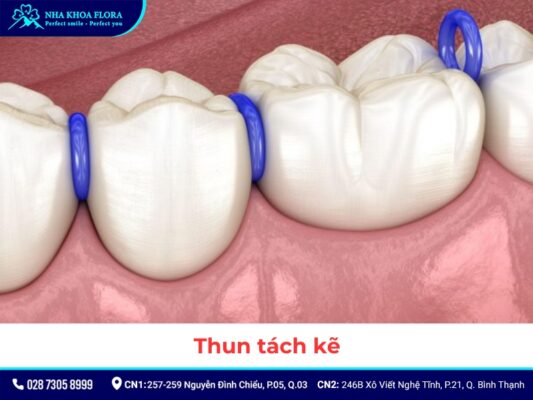 khí cụ niềng răng - ảnh 2 khí cụ niềng răng - ảnh 2
