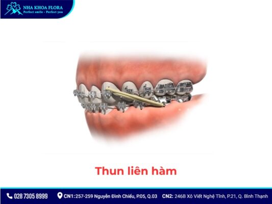 khí cụ niềng răng - ảnh 3 khí cụ niềng răng - ảnh 3
