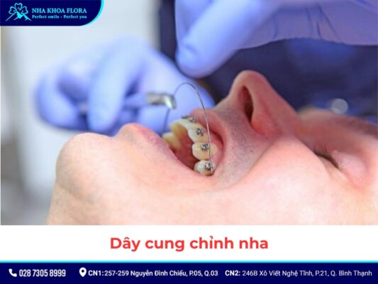 khí cụ niềng răng - ảnh 5 khí cụ niềng răng - ảnh 5