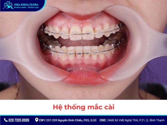 khí cụ niềng răng - ảnh 6 khí cụ niềng răng - ảnh 6