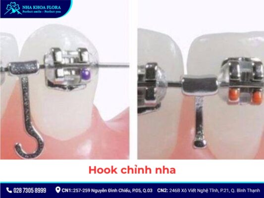khí cụ niềng răng - ảnh 7 khí cụ niềng răng - ảnh 7