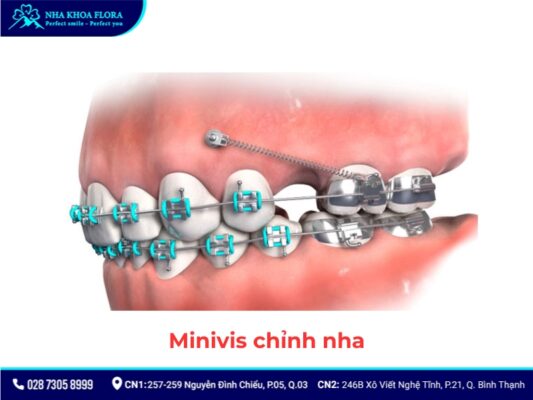 khí cụ niềng răng - ảnh 8 khí cụ niềng răng - ảnh 8