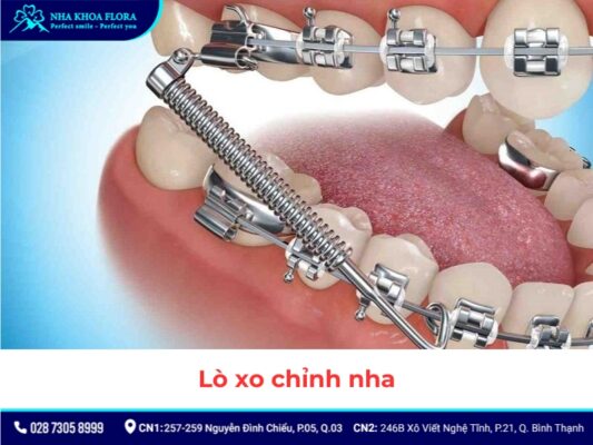 khí cụ niềng răng - ảnh 9 khí cụ niềng răng - ảnh 9
