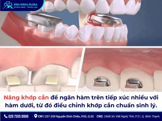 nâng khớp cắn niềng răng - ảnh 1 nâng khớp cắn niềng răng - ảnh 1