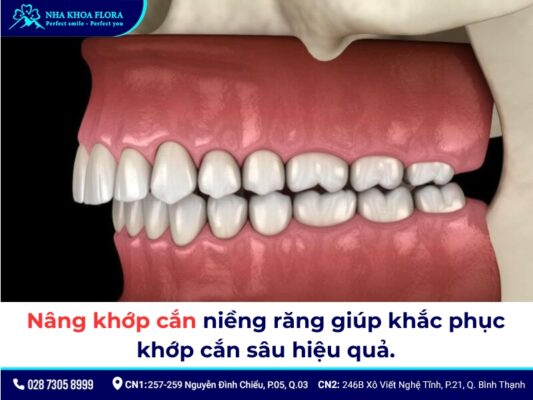 nâng khớp cắn niềng răng - ảnh 2 nâng khớp cắn niềng răng - ảnh 2