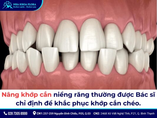 nâng khớp cắn niềng răng - ảnh 3 nâng khớp cắn niềng răng - ảnh 3