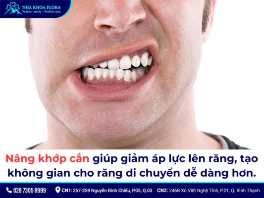 nâng khớp cắn niềng răng - ảnh 4 nâng khớp cắn niềng răng - ảnh 4
