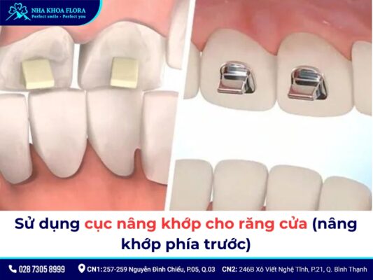 nâng khớp cắn niềng răng - ảnh 6 nâng khớp cắn niềng răng - ảnh 6