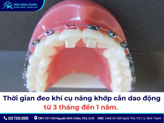 nâng khớp cắn niềng răng - ảnh 7 nâng khớp cắn niềng răng - ảnh 7