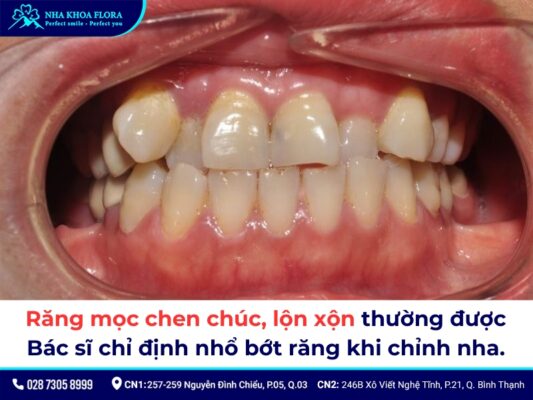 niềng răng có phải nhổ răng không - ảnh 1 niềng răng có phải nhổ răng không - ảnh 1