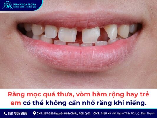 niềng răng có phải nhổ răng không - ảnh 2 niềng răng có phải nhổ răng không - ảnh 2