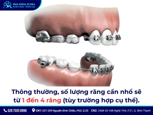 niềng răng có phải nhổ răng không - ảnh 3 niềng răng có phải nhổ răng không - ảnh 3