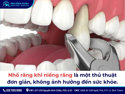niềng răng có phải nhổ răng không - ảnh 4 niềng răng có phải nhổ răng không - ảnh 4