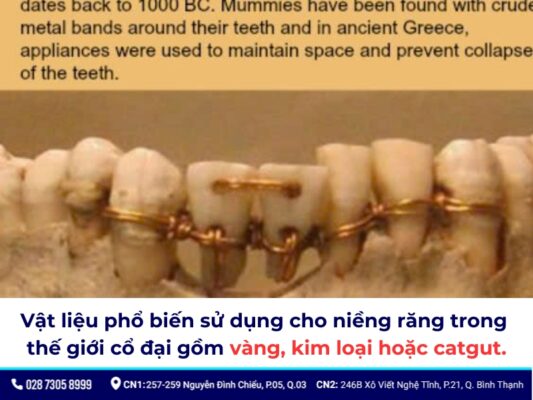 niềng răng thời xưa - ảnh 1 niềng răng thời xưa - ảnh 1