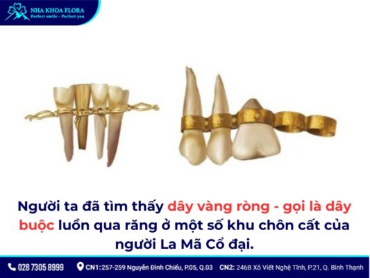 niềng răng thời xưa - ảnh 2 niềng răng thời xưa - ảnh 2