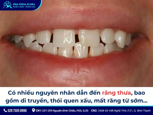 niềng răng thưa - ảnh 1 niềng răng thưa - ảnh 1