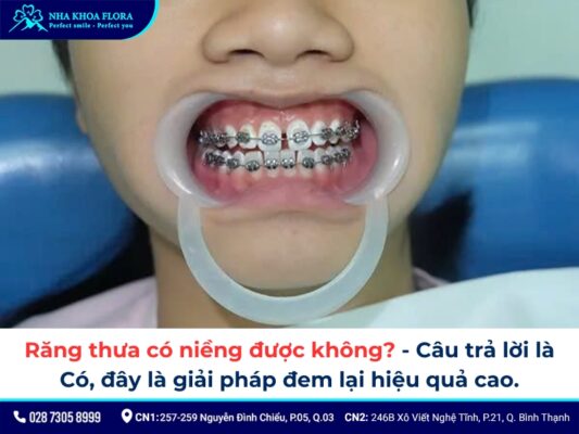 niềng răng thưa - ảnh 2 niềng răng thưa - ảnh 2