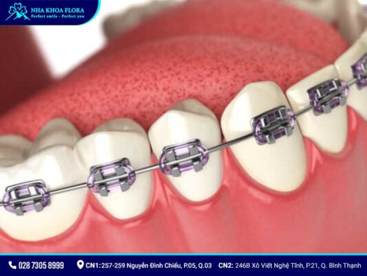 niềng răng thưa - ảnh 6 niềng răng thưa - ảnh 6