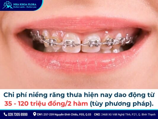 niềng răng thưa - ảnh 7 niềng răng thưa - ảnh 7