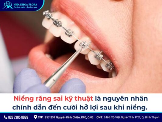 niềng răng xong bị cười hở lợi - ảnh 1 niềng răng xong bị cười hở lợi - ảnh 1