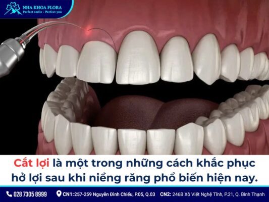 niềng răng xong bị cười hở lợi - ảnh 4 niềng răng xong bị cười hở lợi - ảnh 4