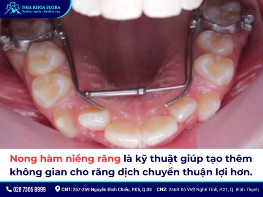 nong hàm niềng răng - ảnh 1 nong hàm niềng răng - ảnh 1