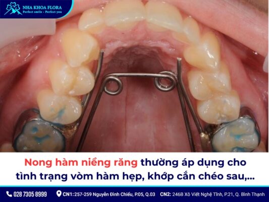 nong hàm niềng răng - ảnh 2 nong hàm niềng răng - ảnh 2