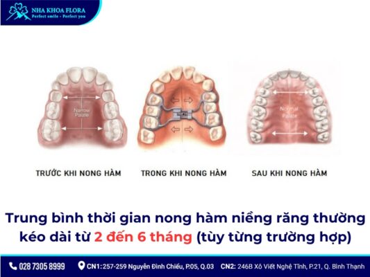 nong hàm niềng răng - ảnh 6 nong hàm niềng răng - ảnh 6