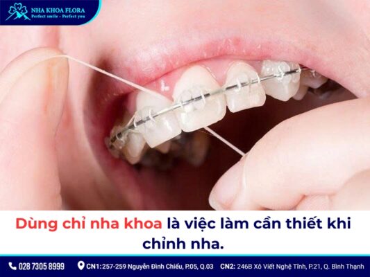 cách dùng chỉ nha khoa khi niềng răng - ảnh 2 cách dùng chỉ nha khoa khi niềng răng - ảnh 2