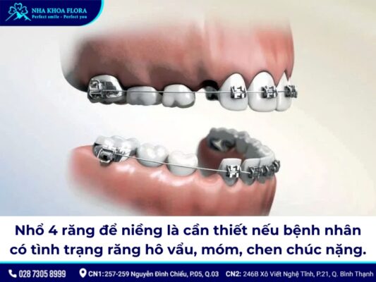 nhổ 4 răng để niềng răng - ảnh 1 nhổ 4 răng để niềng răng - ảnh 1