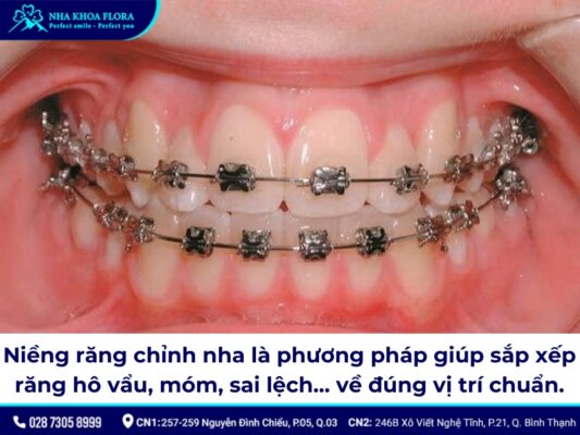 những trường hợp không được niềng răng - ảnh 1 những trường hợp không được niềng răng - ảnh 1