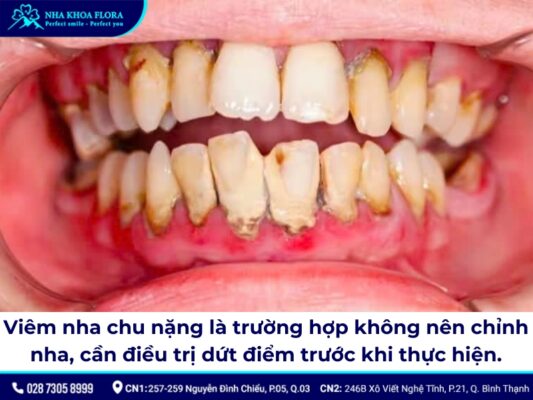 những trường hợp không được niềng răng - ảnh 3 những trường hợp không được niềng răng - ảnh 3