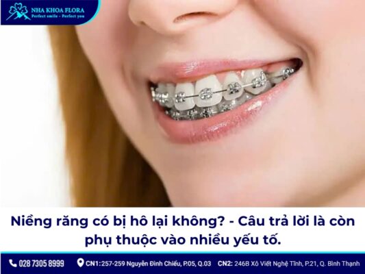 niềng răng có bị hô lại không - ảnh 1 niềng răng có bị hô lại không - ảnh 1