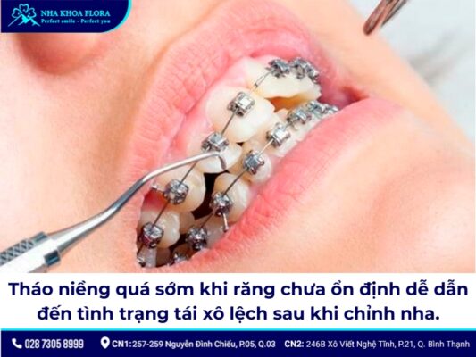 niềng răng có bị hô lại không - ảnh 4 niềng răng có bị hô lại không - ảnh 4