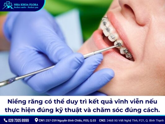 niềng răng có được vĩnh viễn không - ảnh 1 niềng răng có được vĩnh viễn không - ảnh 1