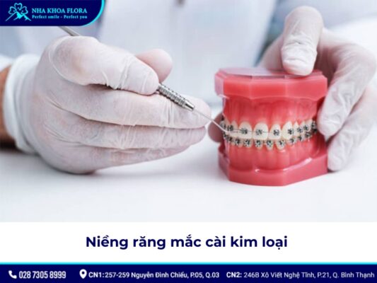 niềng răng có được vĩnh viễn không - ảnh 2 niềng răng có được vĩnh viễn không - ảnh 2