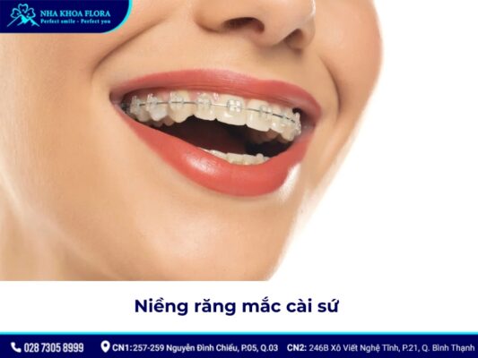 niềng răng có được vĩnh viễn không - ảnh 3 niềng răng có được vĩnh viễn không - ảnh 3