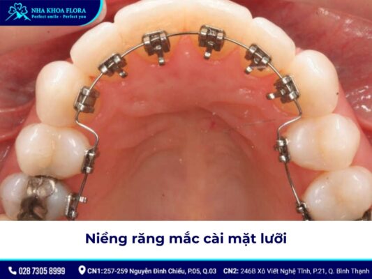 niềng răng có được vĩnh viễn không - ảnh 4 niềng răng có được vĩnh viễn không - ảnh 4