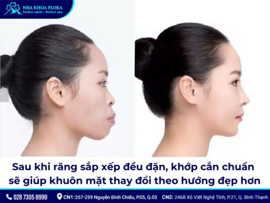 niềng răng có làm thay đổi khuôn mặt - ảnh 1 niềng răng có làm thay đổi khuôn mặt - ảnh 1