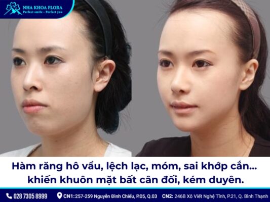 niềng răng có làm thay đổi khuôn mặt - ảnh 2 niềng răng có làm thay đổi khuôn mặt - ảnh 2