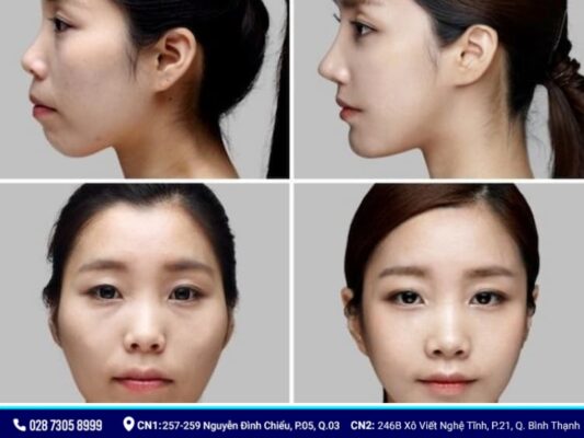 niềng răng có làm thay đổi khuôn mặt - ảnh 3 niềng răng có làm thay đổi khuôn mặt - ảnh 3