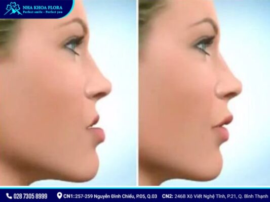 niềng răng có làm thay đổi khuôn mặt - ảnh 4 niềng răng có làm thay đổi khuôn mặt - ảnh 4