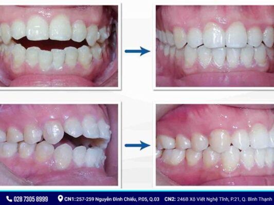 niềng răng có làm thay đổi khuôn mặt - ảnh 6 niềng răng có làm thay đổi khuôn mặt - ảnh 6