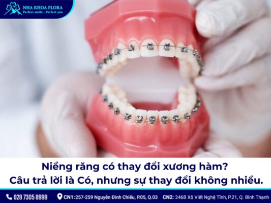 niềng răng có thay đổi xương hàm - ảnh 1 niềng răng có thay đổi xương hàm - ảnh 1