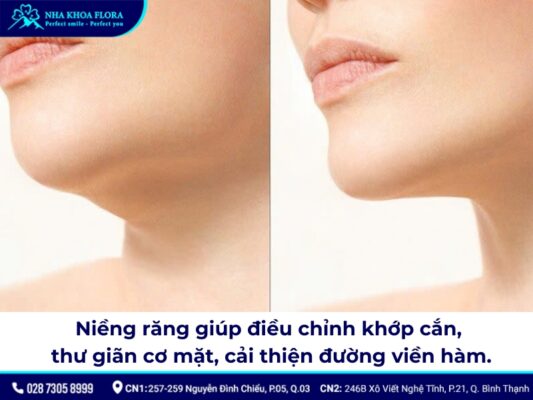 niềng răng có thay đổi xương hàm - ảnh 2 niềng răng có thay đổi xương hàm - ảnh 2