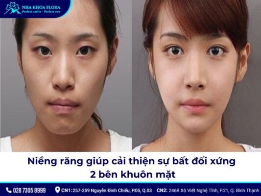 niềng răng có thay đổi xương hàm - ảnh 3 niềng răng có thay đổi xương hàm - ảnh 3