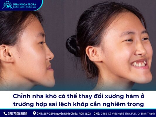 niềng răng có thay đổi xương hàm - ảnh 4 niềng răng có thay đổi xương hàm - ảnh 4