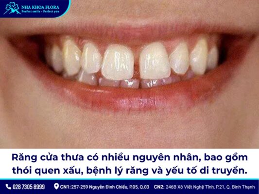 niềng răng cửa thưa - ảnh 2 niềng răng cửa thưa - ảnh 2