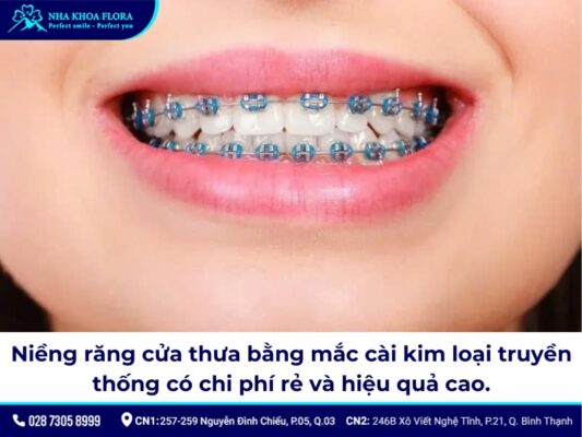 niềng răng cửa thưa - ảnh 3 niềng răng cửa thưa - ảnh 3