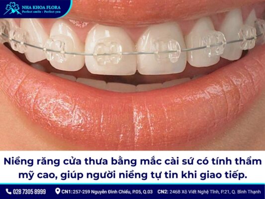 niềng răng cửa thưa - ảnh 4 niềng răng cửa thưa - ảnh 4